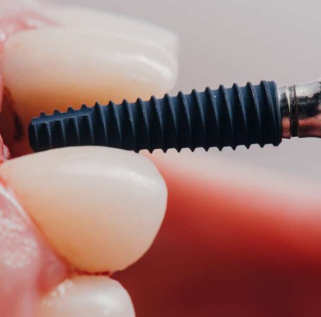 Blog - Sutton Dental & Implant Clinic