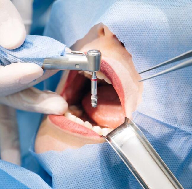 Blog - Sutton Dental & Implant Clinic