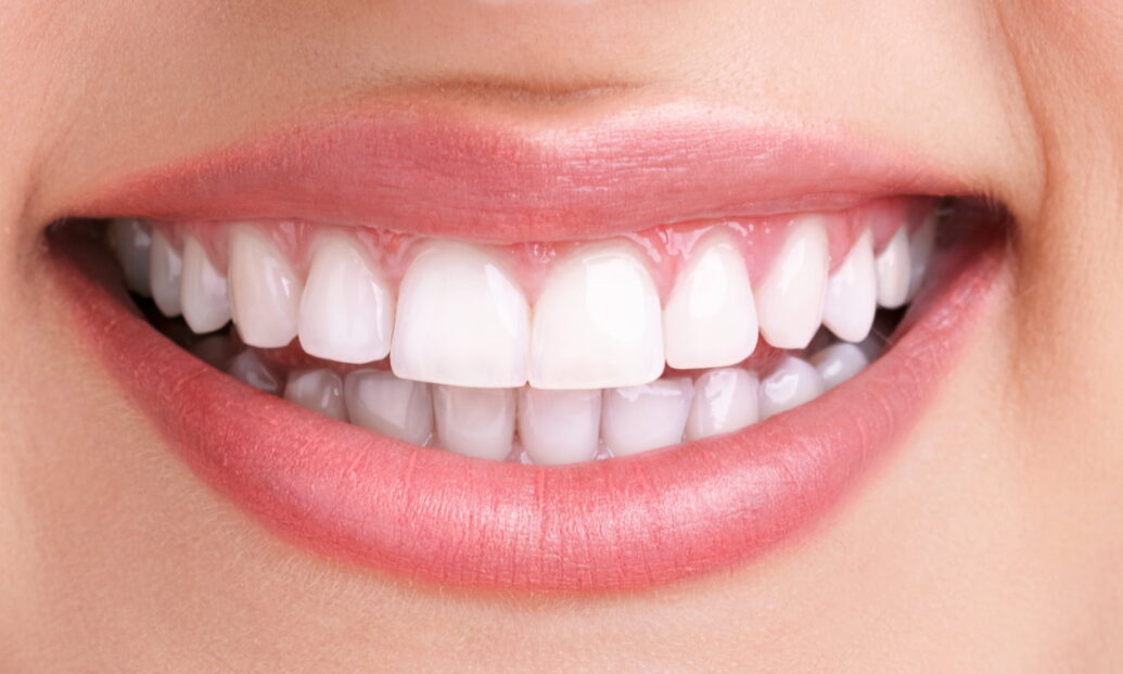 Sutton Dental Dental Composite Bonding