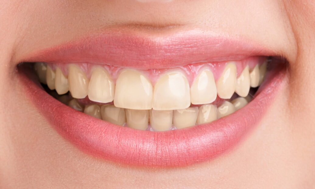 Before - Sutton Dental & Implant Clinic