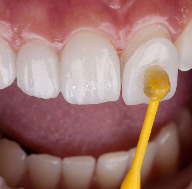 Blog - Sutton Dental & Implant Clinic