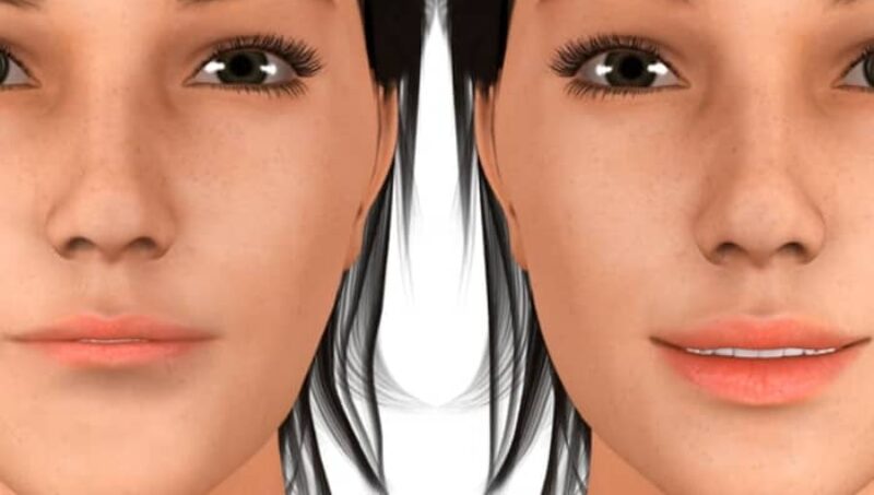 Sutton Dental Dermal Fillers Video