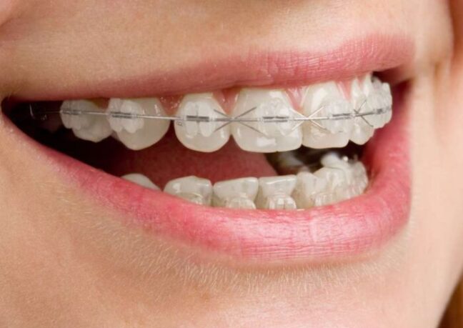 Sutton Dental fixed braces