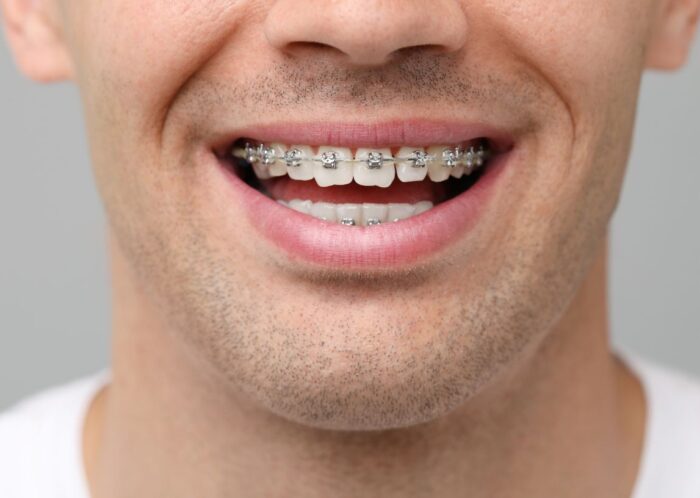 Sutton Dental fixed braces