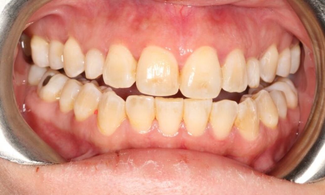 Sutton Dental Case 11 Before