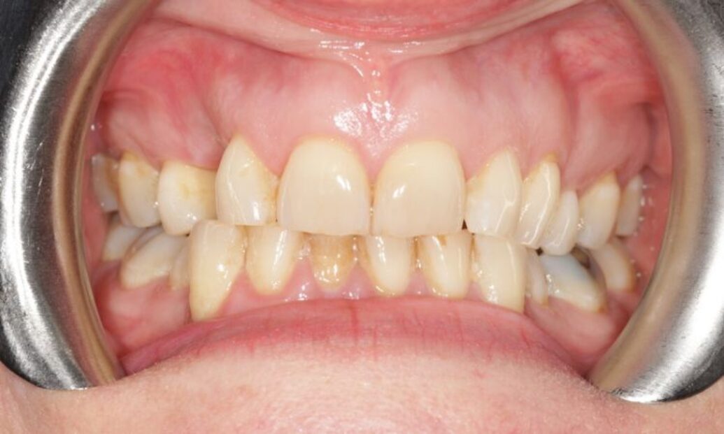 Sutton Dental Case 12 before