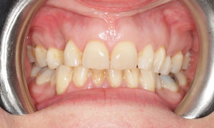 Sutton Dental Case 12 before