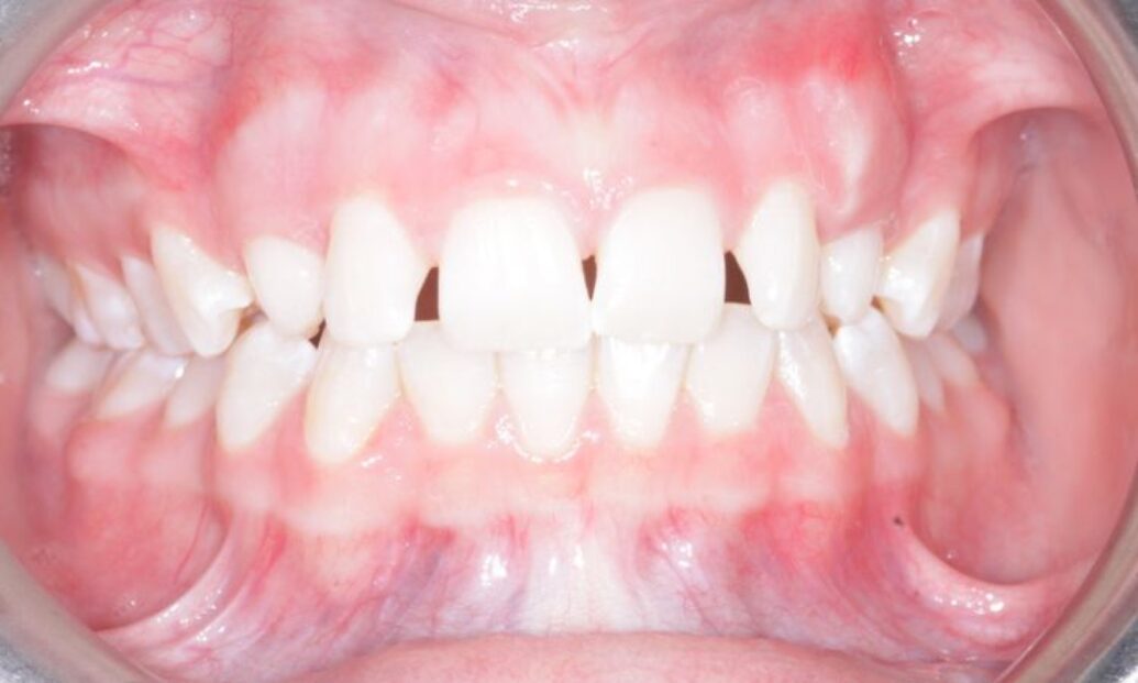 Sutton Dental Case10 Before