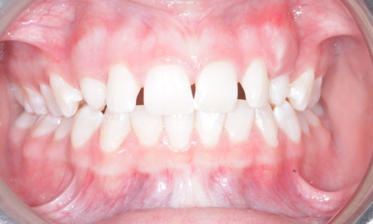 Sutton Dental Case10 Before