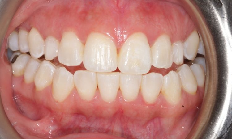 Sutton Dental Case 11 After