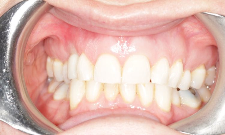 Sutton Dental Case 12 After