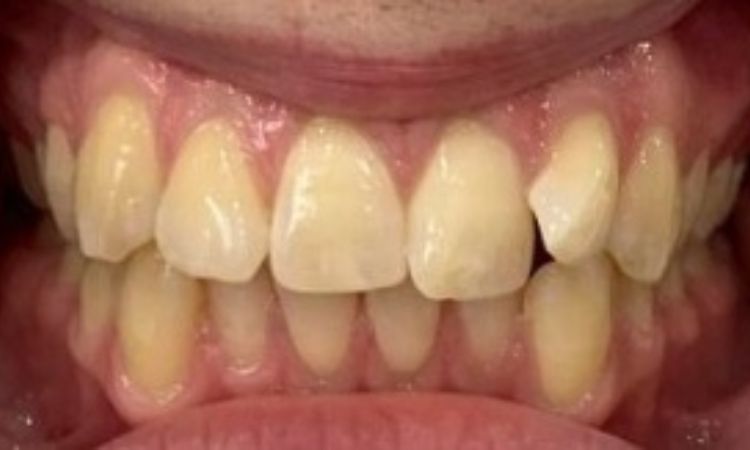 Sutton Dental Case 14 Before