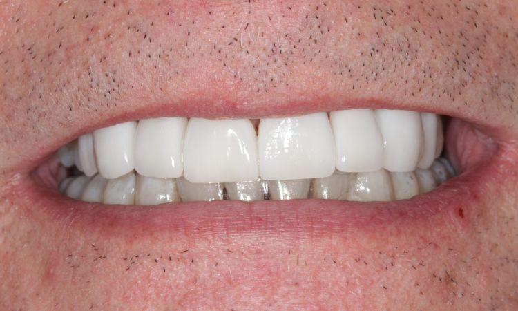 Sutton Dental Case 15 After