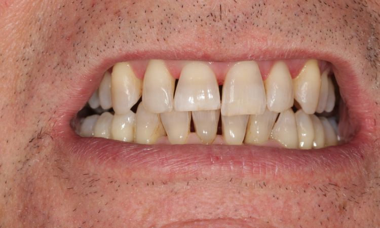 Sutton Dental Case15 Before
