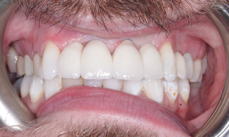 After - Sutton Dental & Implant Clinic