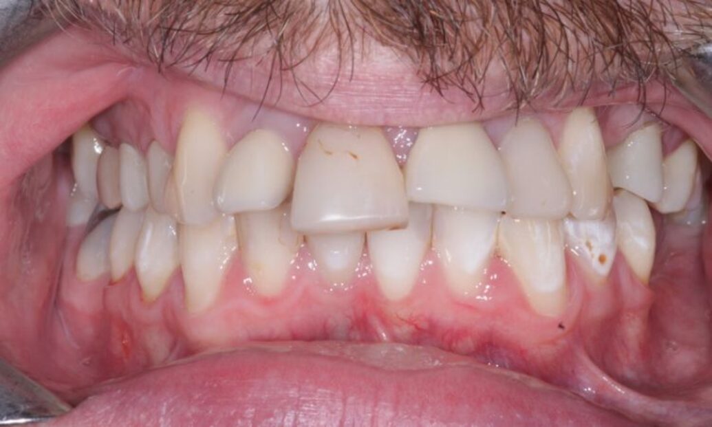 Before - Sutton Dental & Implant Clinic
