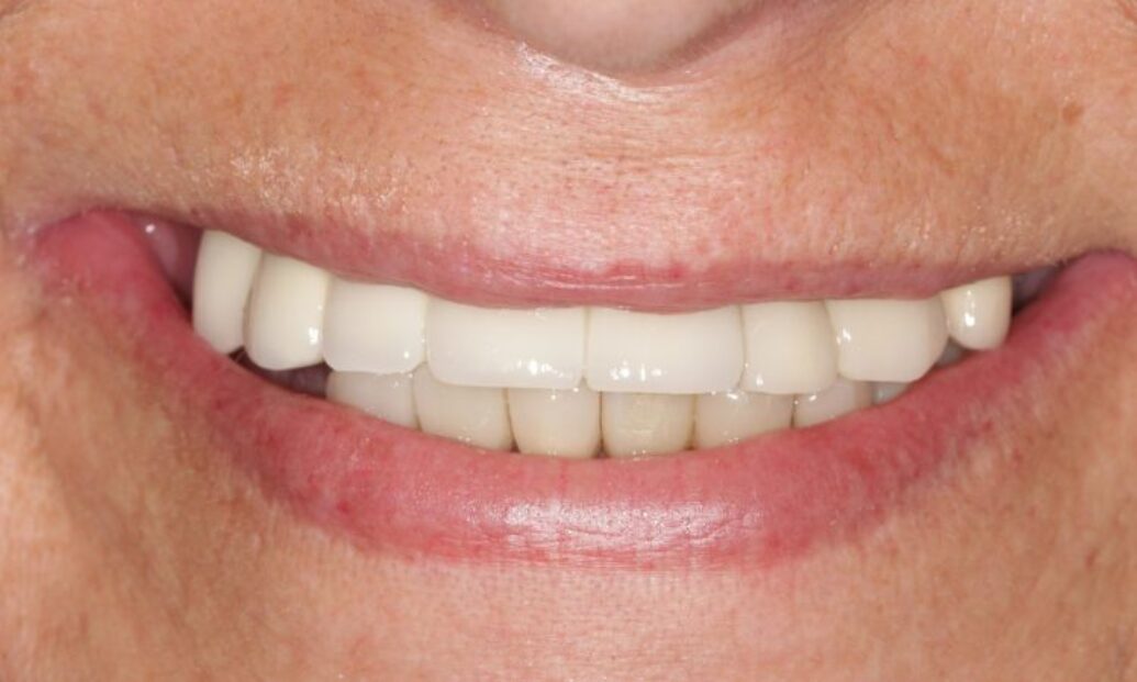 Sutton Dental Case 8 After