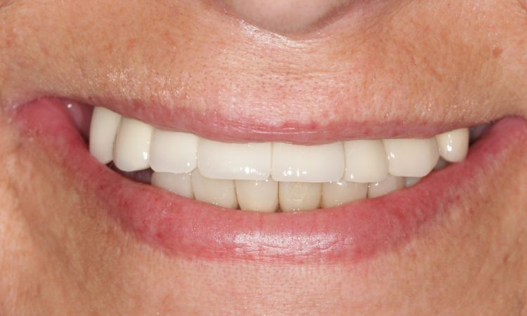 Sutton Dental Case 8 After