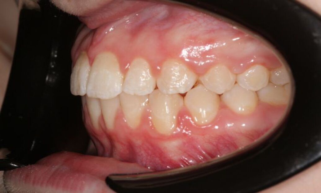 Sutton Dental Case 9 After