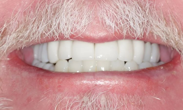 After - Sutton Dental & Implant Clinic