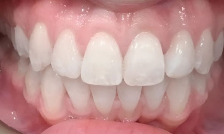 After - Sutton Dental & Implant Clinic