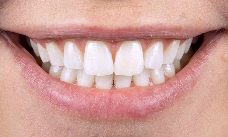 After - Sutton Dental & Implant Clinic