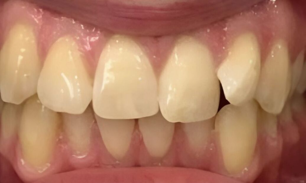 Before - Sutton Dental & Implant Clinic
