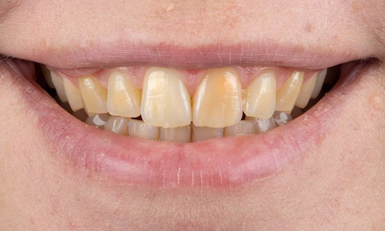 Before - Sutton Dental & Implant Clinic