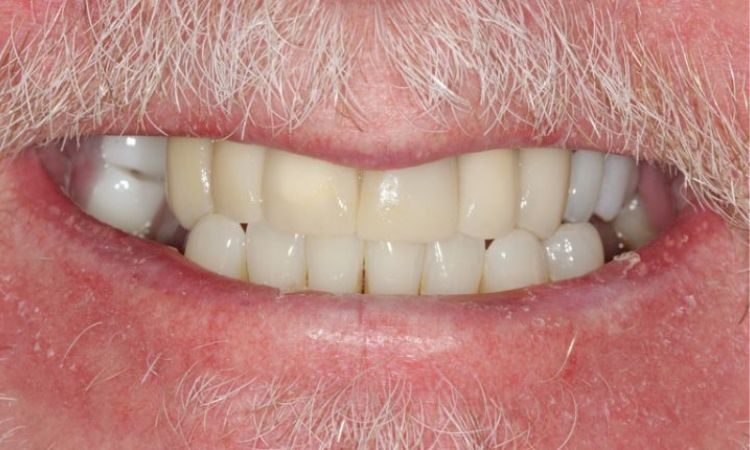 Before - Sutton Dental & Implant Clinic