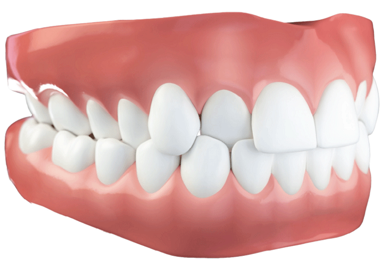 invisalign before after