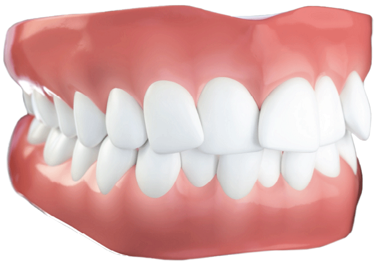 invisalign before after