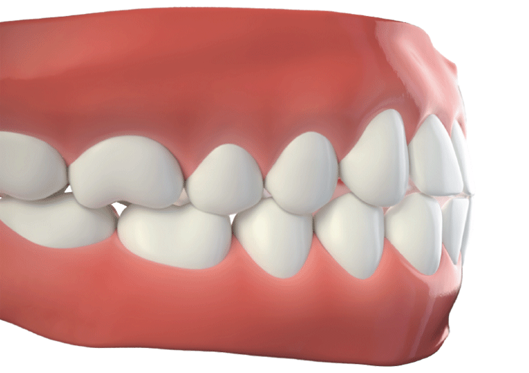 invisalign before after
