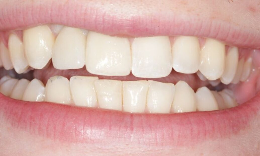 After - Sutton Dental & Implant Clinic