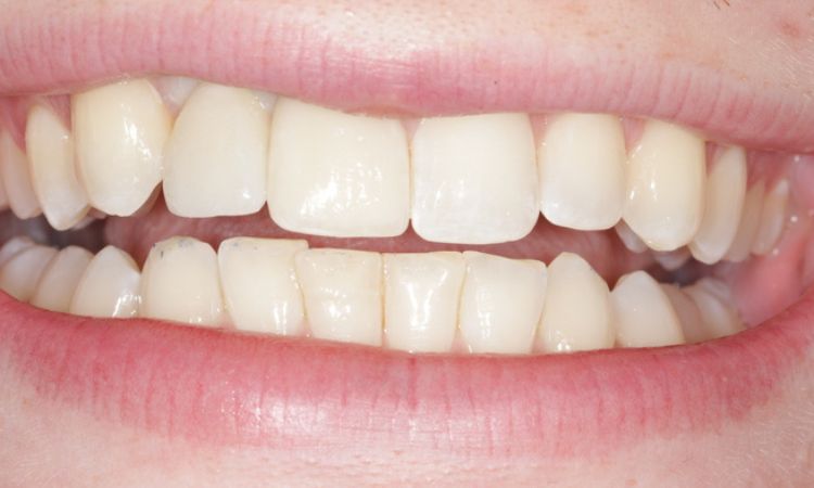 After - Sutton Dental & Implant Clinic