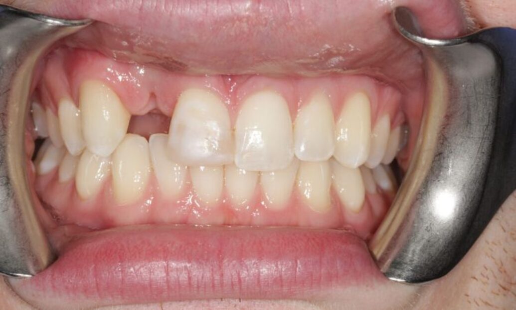 Before - Sutton Dental & Implant Clinic