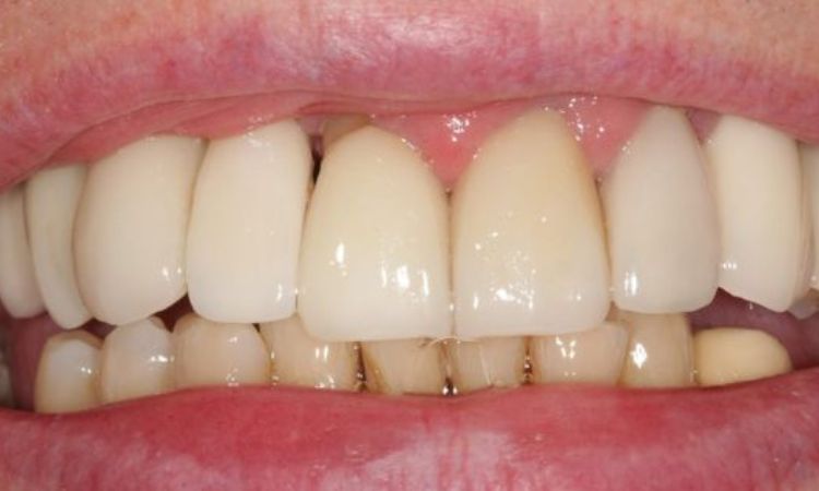 After - Sutton Dental & Implant Clinic