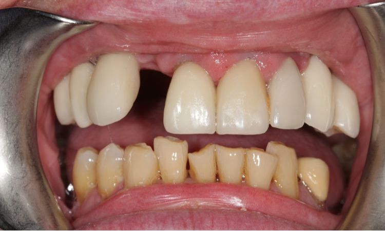 Before - Sutton Dental & Implant Clinic