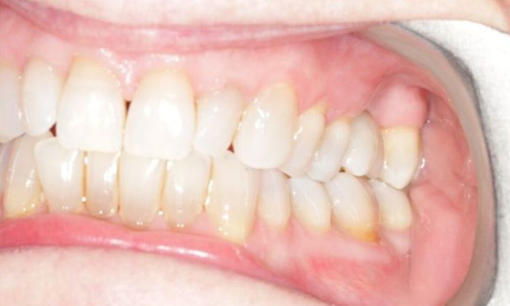 After - Sutton Dental & Implant Clinic