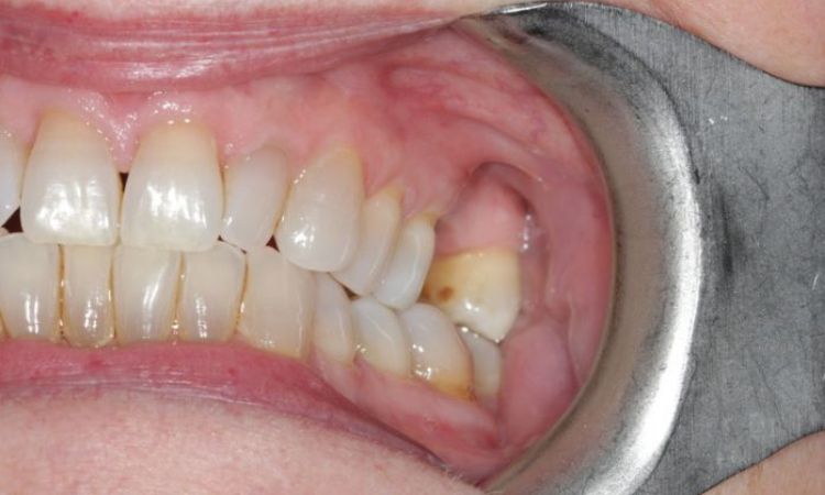 Before - Sutton Dental & Implant Clinic