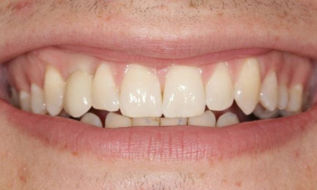 After - Sutton Dental & Implant Clinic