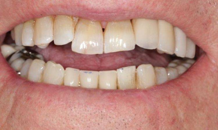 After - Sutton Dental & Implant Clinic