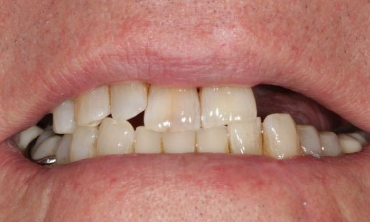 Before - Sutton Dental & Implant Clinic