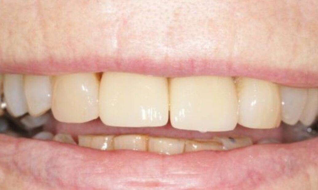 After - Sutton Dental & Implant Clinic