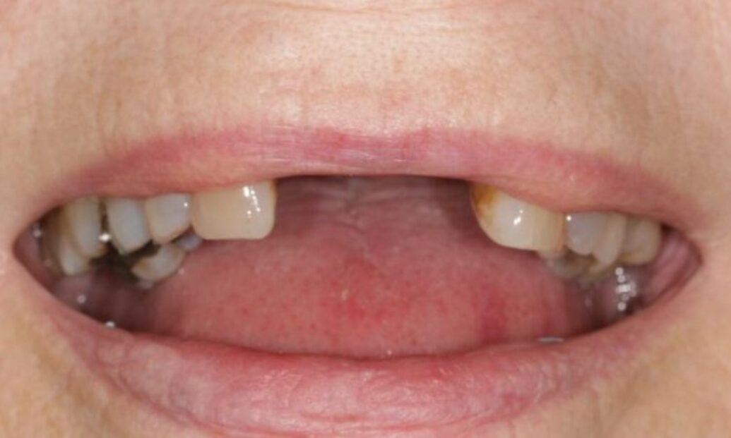 Before - Sutton Dental & Implant Clinic