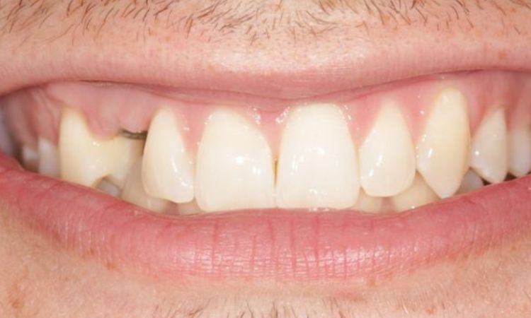 Before - Sutton Dental & Implant Clinic