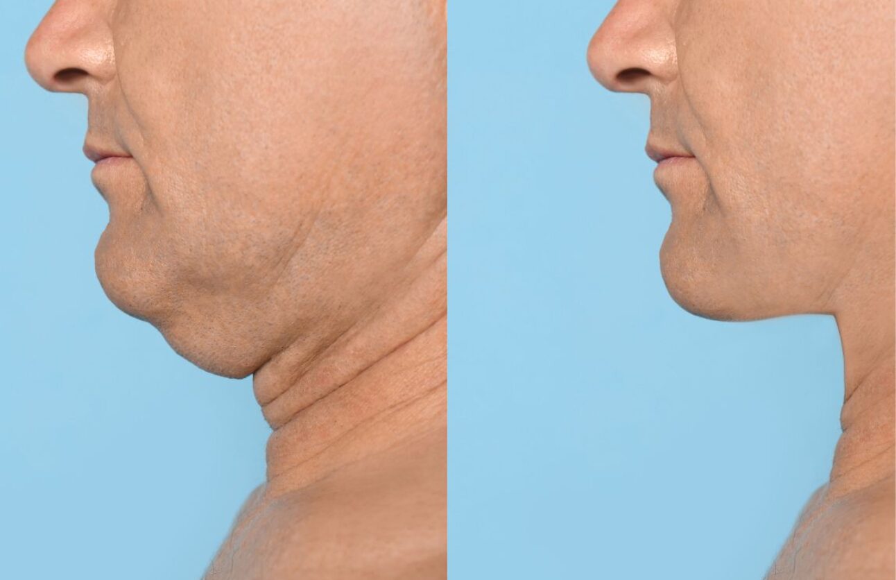 Sutton Dental Clinic Fat Dissolver